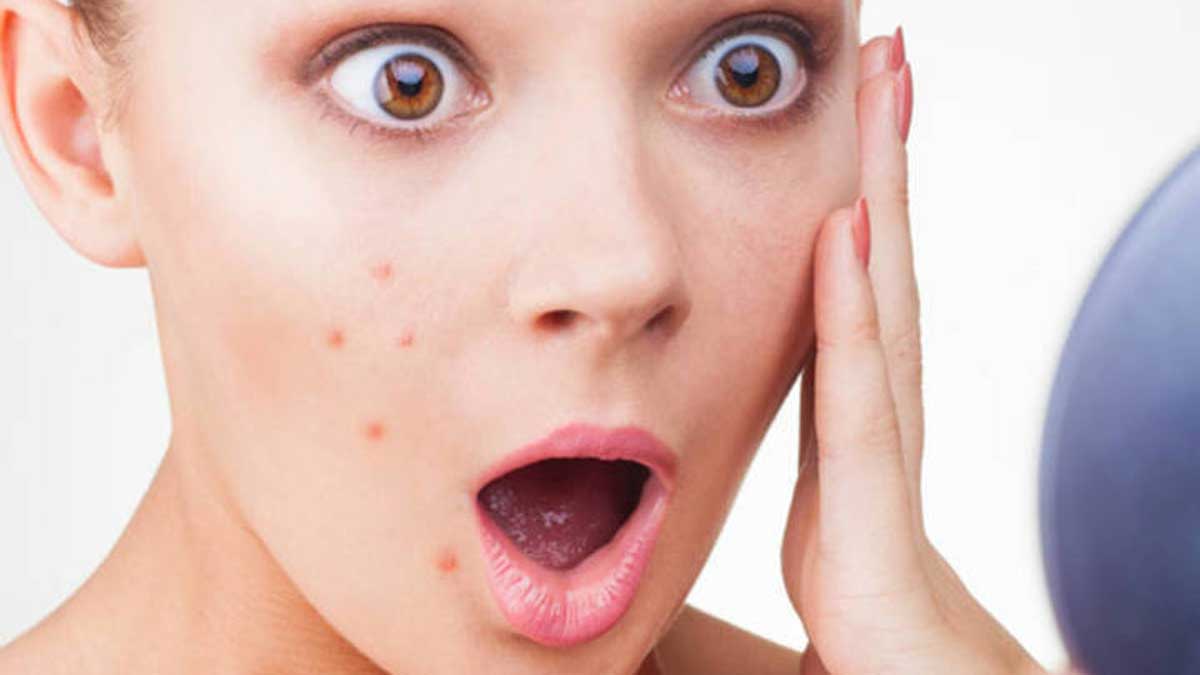 Reasons That Cause Pimples The Health Blog Fidoc